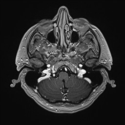 Cerebral arteriovenous malformation (Radiopaedia 84015-99245 Axial T1 C+ 34).jpg