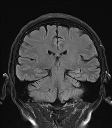 File:Cerebral arteriovenous malformation (Radiopaedia 84015-99245 Coronal FLAIR 20).jpg