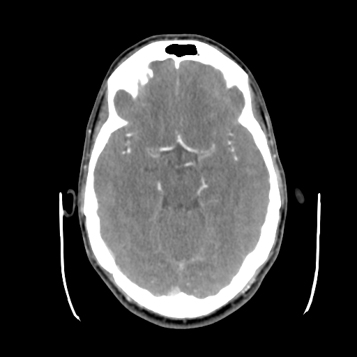 Cerebral arteriovenous malformation (Spetzler-Martin grade 2) (Radiopaedia 41262-44076 Axial C+ 20).png