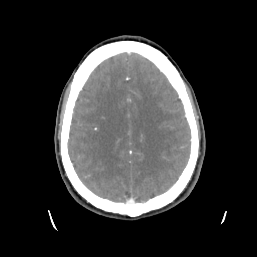 Cerebral arteriovenous malformation (Spetzler-Martin grade 2) (Radiopaedia 41262-44076 Axial C+ 37).png