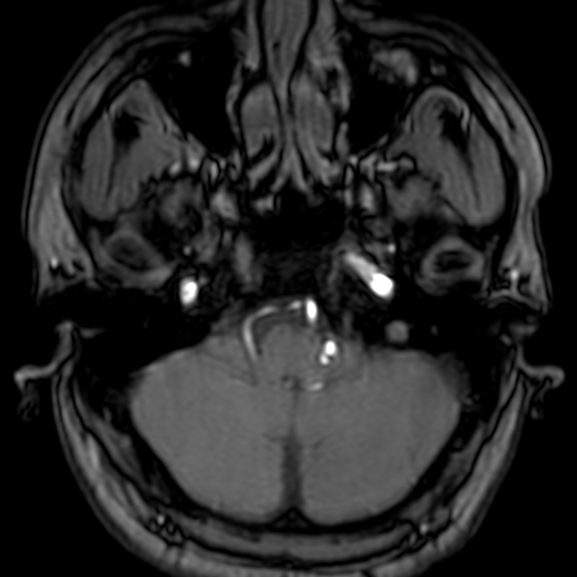 Cerebral arteriovenous malformation at posterior body of corpus callosum (Radiopaedia 74111-84925 Axial MRA 27).jpg