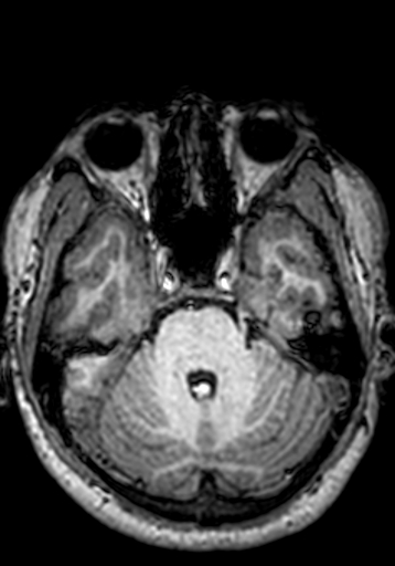 Cerebral arteriovenous malformation at posterior body of corpus callosum (Radiopaedia 74111-84925 Axial T1 223).jpg