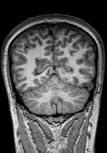 Cerebral arteriovenous malformation at posterior body of corpus callosum (Radiopaedia 74111-84925 Coronal T1 268).jpg