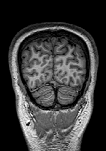 Cerebral arteriovenous malformation at posterior body of corpus callosum (Radiopaedia 74111-84925 Coronal T1 314).jpg
