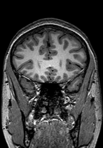 Cerebral arteriovenous malformation at posterior body of corpus callosum (Radiopaedia 74111-84925 Coronal T1 80).jpg