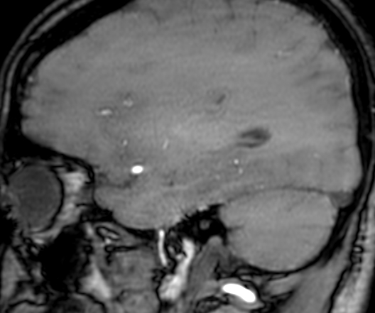 Cerebral arteriovenous malformation at posterior body of corpus callosum (Radiopaedia 74111-84925 J 289).jpg