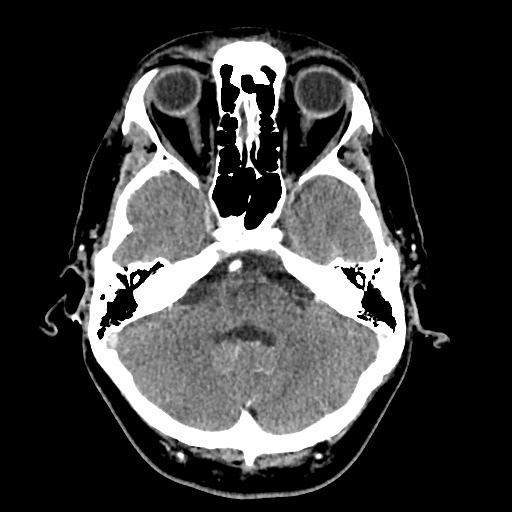 Cerebral arteriovenous malformation with lobar hemorrhage (Radiopaedia 35598-57216 A 15).jpg