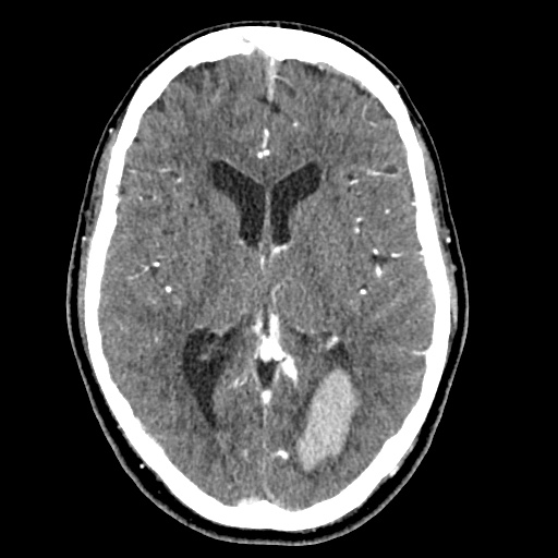 File:Cerebral arteriovenous malformation with lobar hemorrhage (Radiopaedia 35598-57216 A 32).jpg