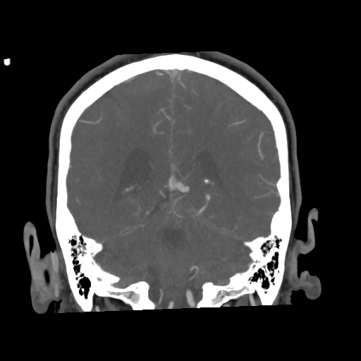 Cerebral arteriovenous malformation with lobar hemorrhage (Radiopaedia 35598-57216 C 63).jpg
