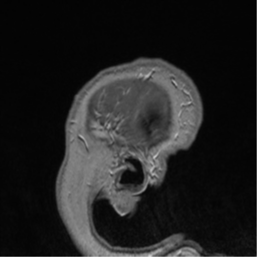 File:Cerebral cavernoma and development venous anomaly (Radiopaedia 37603-39482 Sagittal T1 C+ 8).png