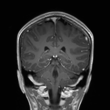File:Cerebral cavernous venous malformation (Radiopaedia 70008-80021 Coronal T1 C+ 24).jpg