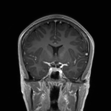 Cerebral cavernous venous malformation (Radiopaedia 70008-80021 Coronal T1 C+ 37).jpg
