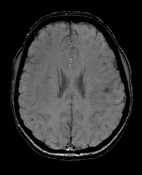 Cerebral cavernous venous malformation (Radiopaedia 70008-80021 I 48).jpg