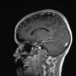 Cerebral cavernous venous malformation (Radiopaedia 70008-80021 Sagittal T1 C+ 43).jpg