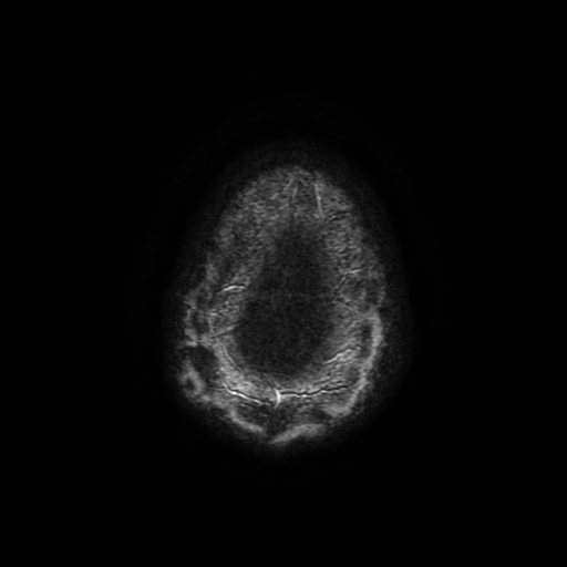 Cerebral cavernous venous malformation (Zabramski type II) (Radiopaedia 85511-101198 Axial SWI 116).jpg