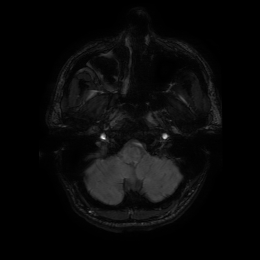 Cerebral cavernous venous malformation (Zabramski type II) (Radiopaedia 85511-101198 Axial SWI 19).jpg