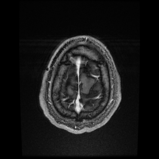 Cerebral cavernous venous malformation (Zabramski type II) (Radiopaedia 85511-101198 Axial T1 C+ fat sat 14).jpg