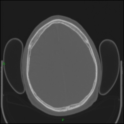 Cerebral contusions (Radiopaedia 33868-35039 Axial bone window 155).jpg