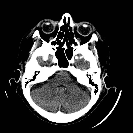 Cerebral edema (evolution in time) (Radiopaedia 19418-19440 non-contrast 28).jpg