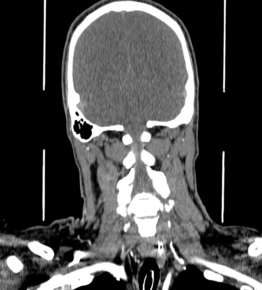 Cerebral edema in an overdose patient (Radiopaedia 72005-82539 B 125).jpg