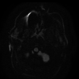 Cerebral embolic infarcts (embolic shower) (Radiopaedia 49837-55108 Axial DWI 94).jpg
