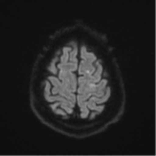 File:Cerebral embolic infarcts (embolic shower) (Radiopaedia 57395-64342 Axial DWI 67).png