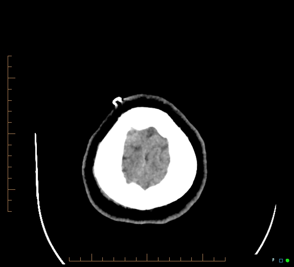 Cerebral fat embolism (Radiopaedia 85521-101220 Axial non-contrast 56).jpg