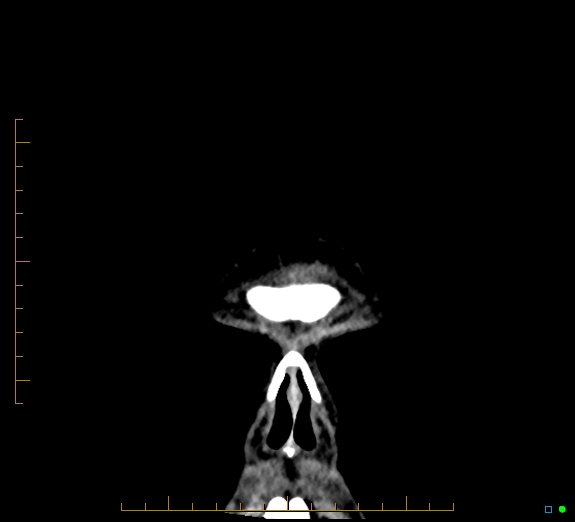 Cerebral fat embolism (Radiopaedia 85521-101224 Coronal non-contrast 3).jpg