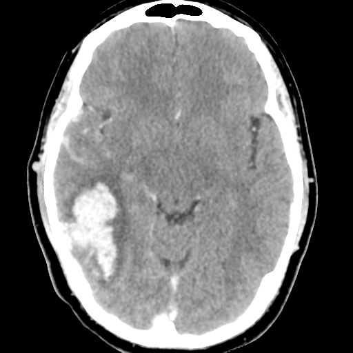 File:Cerebral hemorrhage secondary to arteriovenous malformation (Radiopaedia 33497-34561 B 24).png