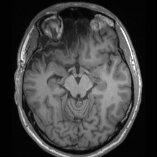 Cerebral hemorrhagic contusions- temporal evolution (Radiopaedia 40224-42757 Axial T1 31).png