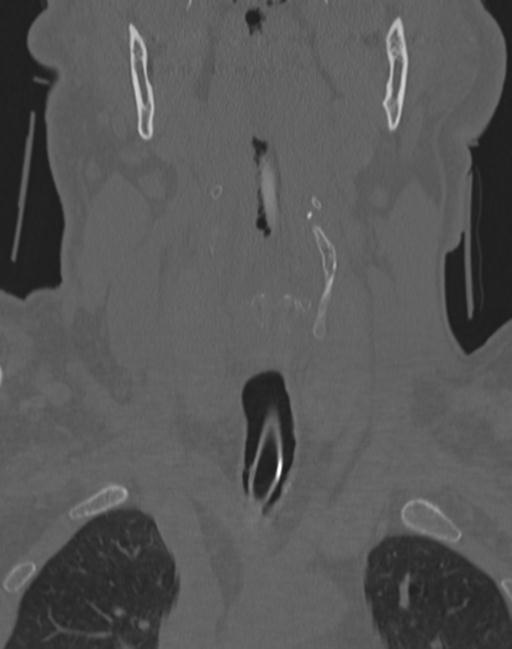Cerebral hemorrhagic contusions and cervical spine fractures (Radiopaedia 32865-33841 Coronal bone window 12).jpg