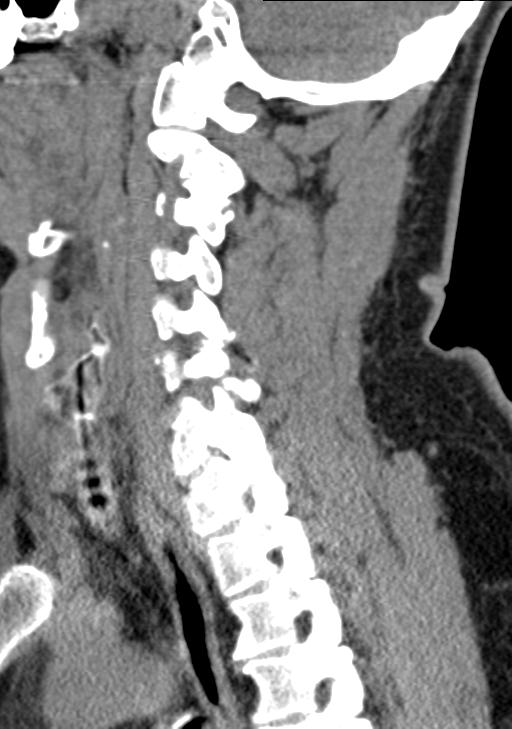 Cerebral hemorrhagic contusions and cervical spine fractures (Radiopaedia 32865-33841 G 49).jpg