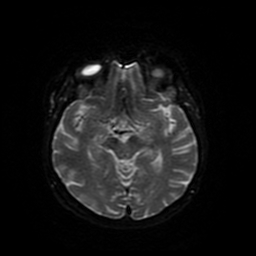Cerebral metastases - melanoma (Radiopaedia 80972-94522 Axial DWI 78).jpg