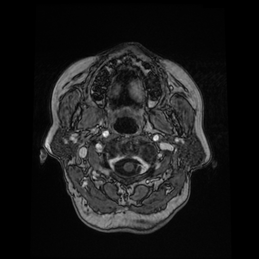 Cerebral metastases - melanoma (Radiopaedia 80972-94522 Axial T1 C+ 17).jpg