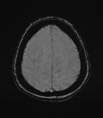 File:Cerebral metastasis to basal ganglia (Radiopaedia 81568-95413 Axial SWI 71).png