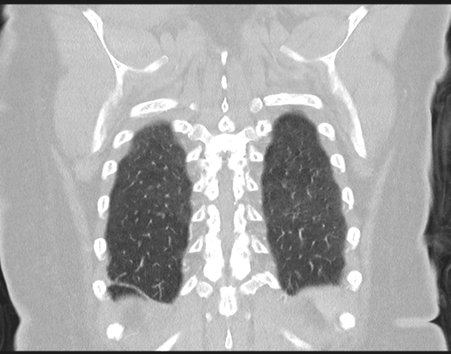File:Cerebral metastasis to basal ganglia (Radiopaedia 81568-95414 Coronal lung window 71).png