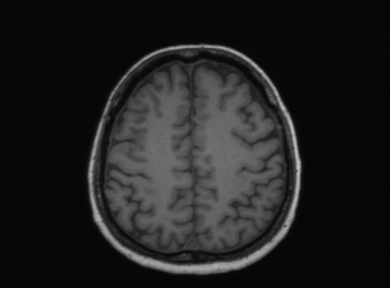Cerebral ring enhancing lesions - cerebral metastases (Radiopaedia 44922-48817 Axial T1 162).jpg