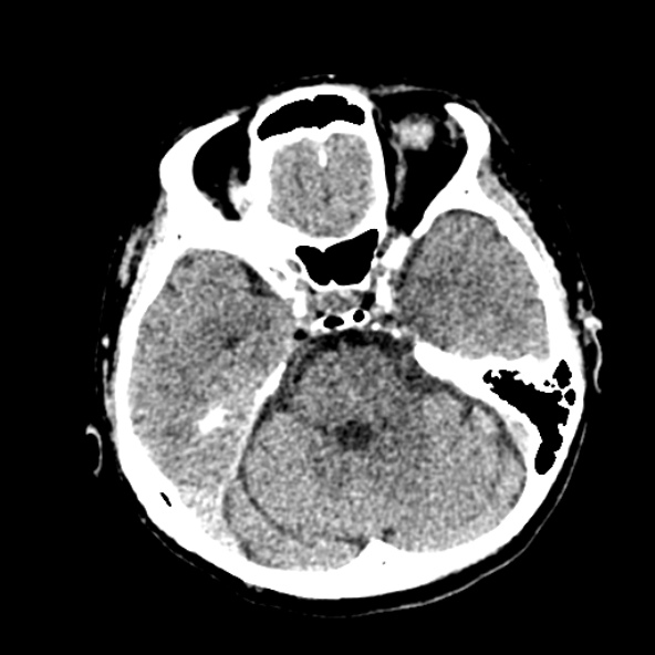Cerebral ring enhancing lesions - cerebral metastases (Radiopaedia 44922-48818 Axial non-contrast 38).jpg