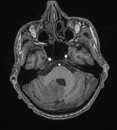 File:Cerebral toxoplasmosis (Radiopaedia 43956-47461 Axial T1 19).jpg