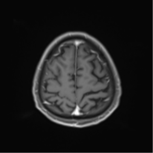 Cerebral toxoplasmosis (Radiopaedia 54575-60804 Axial T1 C+ 46).png