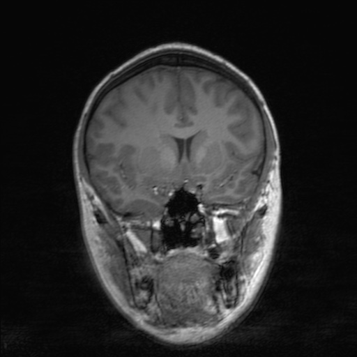 Cerebral tuberculosis with dural sinus invasion (Radiopaedia 60353-68090 Coronal T1 76).jpg