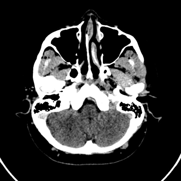 File:Cerebral venous hemorrhagic infarct from venous sinus thrombosis (Radiopaedia 55433-61883 Axial C+ delayed 124).jpg