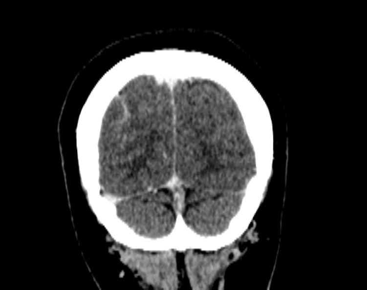 Cerebral venous hemorrhagic infarct from venous sinus thrombosis (Radiopaedia 55433-61883 Coronal C+ delayed 53).jpg