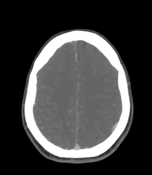 Cerebral venous hemorrhagic infarction (Radiopaedia 38461-40550 Axial MIP VENOGRAM 39).png