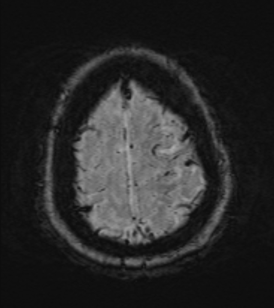 Cerebral venous infarct (Radiopaedia 53627-59685 Axial SWI 49).jpg