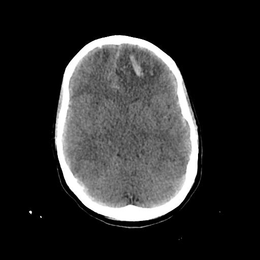 File:Cerebral venous throbmosis - hemorrhagic venous infarction (Radiopaedia 87318-103613 Axial non-contrast 68).jpg