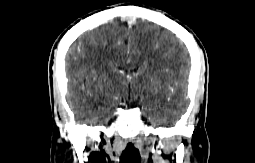 Cerebral venous thrombosis (CVT) (Radiopaedia 77524-89685 C 30).jpg