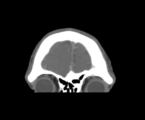 Cerebral venous thrombosis (Radiopaedia 38392-40467 Coronal CTA-Venogram 9).png
