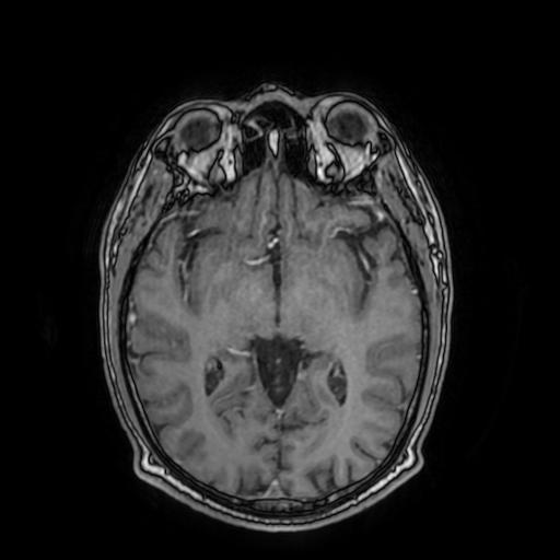 File:Cerebral venous thrombosis with secondary intracranial hypertension (Radiopaedia 89842-106957 Axial T1 C+ 89).jpg