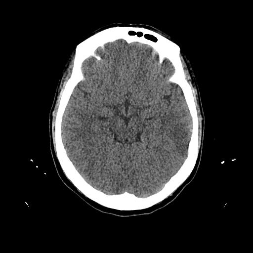 Cerebral venous thrombosis with venous hemorrhagic infarct (Radiopaedia 90354-107660 Axial non-contrast 21).jpg